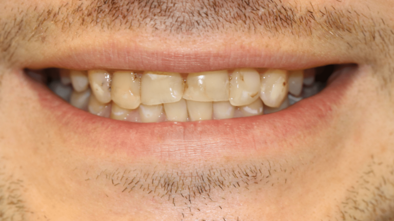 BEFORE-MARCH-30-1