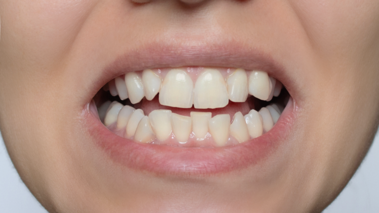 Invisalign-Before