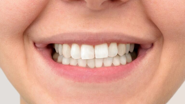 Teeth-Whitening-After-scaled